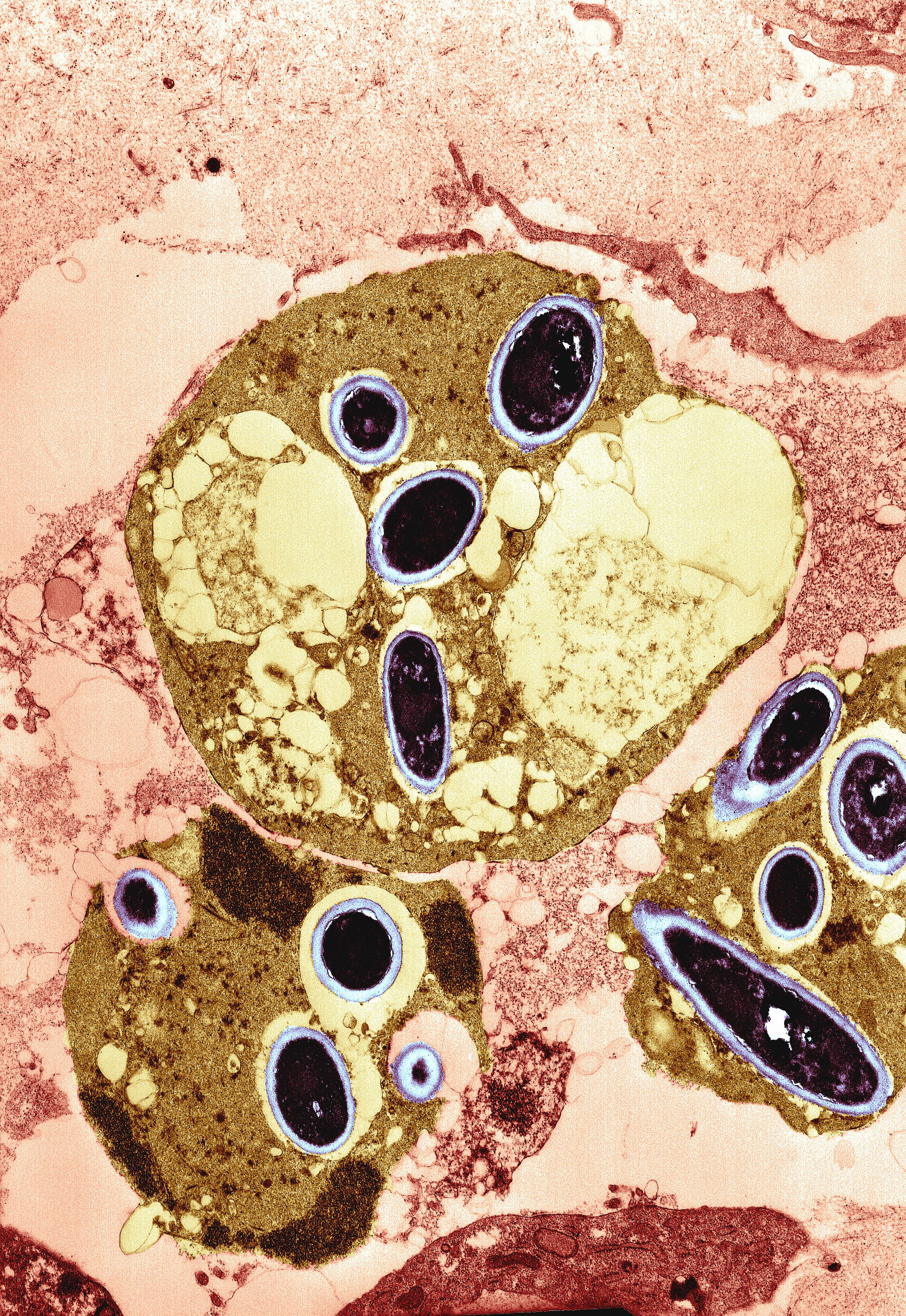 Stromal lymphocytes - coloured